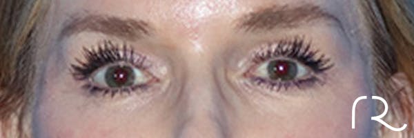 Eyelid Surgery Before & After Gallery - Patient 168494171 - Image 2