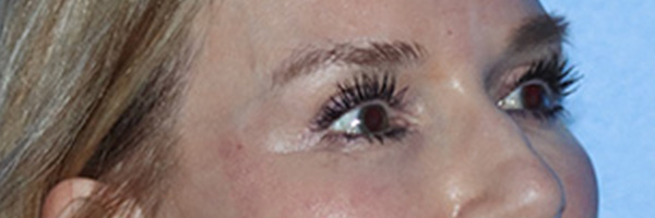 Eyelid Surgery Before & After Gallery - Patient 168494171 - Image 3