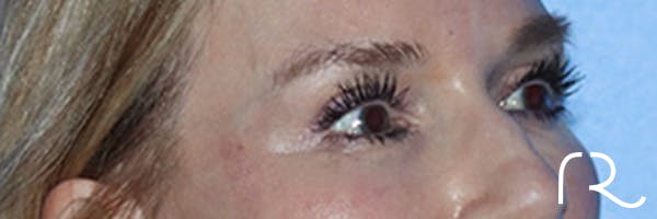 Eyelid Surgery Before & After Gallery - Patient 168494171 - Image 3