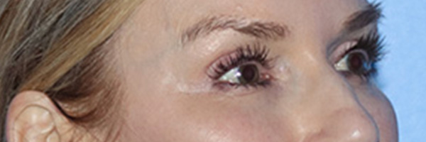 Eyelid Surgery Before & After Gallery - Patient 168494171 - Image 4