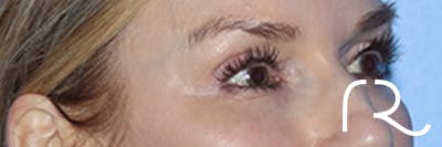 Eyelid Surgery Before & After Gallery - Patient 168494171 - Image 4