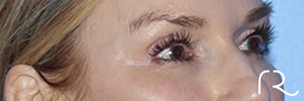 Eyelid Surgery Before & After Gallery - Patient 168494171 - Image 4