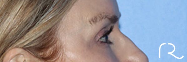 Eyelid Surgery Before & After Gallery - Patient 168494171 - Image 5