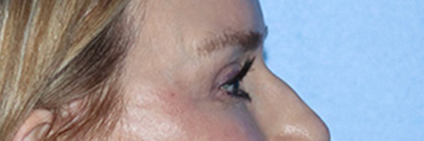 Eyelid Surgery Before & After Gallery - Patient 168494171 - Image 6