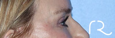Eyelid Surgery Before & After Gallery - Patient 168494171 - Image 6