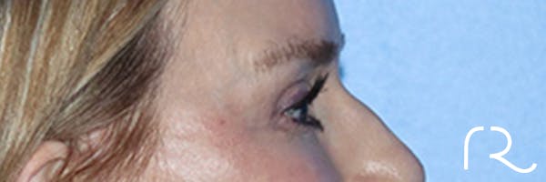 Eyelid Surgery Before & After Gallery - Patient 168494171 - Image 6
