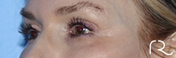 Eyelid Surgery Before & After Gallery - Patient 168494171 - Image 7