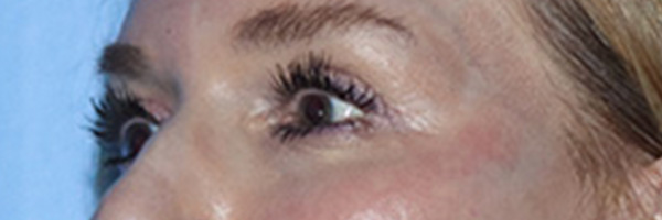 Eyelid Surgery Before & After Gallery - Patient 168494171 - Image 8