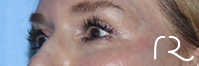 Eyelid Surgery Before & After Gallery - Patient 168494171 - Image 8