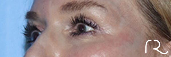 Eyelid Surgery Before & After Gallery - Patient 168494171 - Image 8