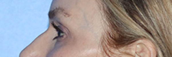 Eyelid Surgery Before & After Gallery - Patient 168494171 - Image 9