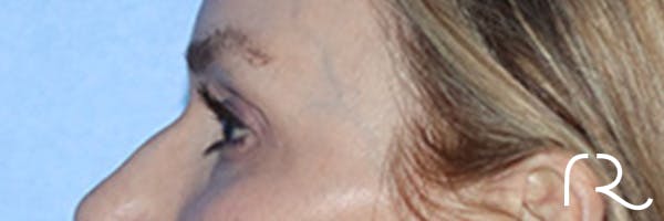 Eyelid Surgery Before & After Gallery - Patient 168494171 - Image 9