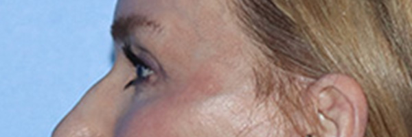 Eyelid Surgery Before & After Gallery - Patient 168494171 - Image 10