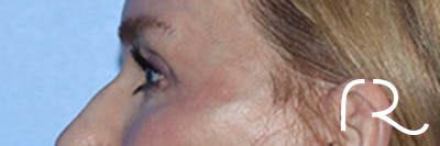 Eyelid Surgery Before & After Gallery - Patient 168494171 - Image 10