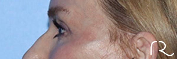 Eyelid Surgery Before & After Gallery - Patient 168494171 - Image 10