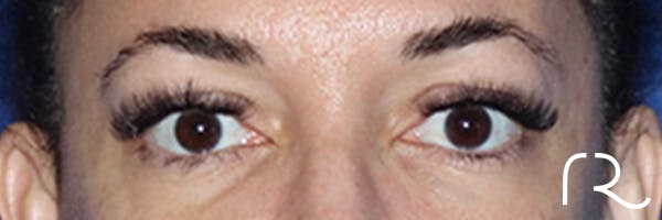Eyelid Surgery Before & After Gallery - Patient 168494185 - Image 1
