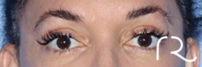Eyelid Surgery Before & After Gallery - Patient 168494185 - Image 2