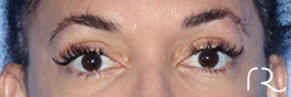 Eyelid Surgery Before & After Gallery - Patient 168494185 - Image 2