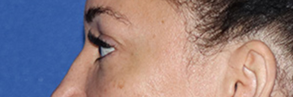 Eyelid Surgery Before & After Gallery - Patient 168494185 - Image 3