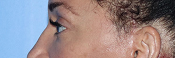 Eyelid Surgery Before & After Gallery - Patient 168494185 - Image 4