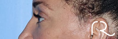 Eyelid Surgery Before & After Gallery - Patient 168494185 - Image 4