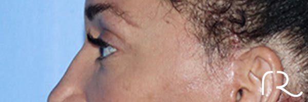 Eyelid Surgery Before & After Gallery - Patient 168494185 - Image 4