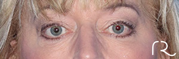 Eyelid Surgery Before & After Gallery - Patient 168494313 - Image 1