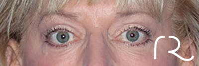 Eyelid Surgery Before & After Gallery - Patient 168494313 - Image 2