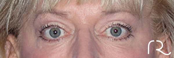 Eyelid Surgery Before & After Gallery - Patient 168494313 - Image 2