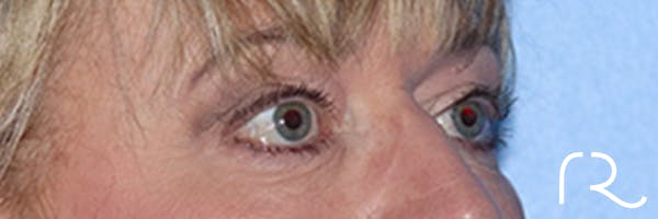 Eyelid Surgery Before & After Gallery - Patient 168494313 - Image 3