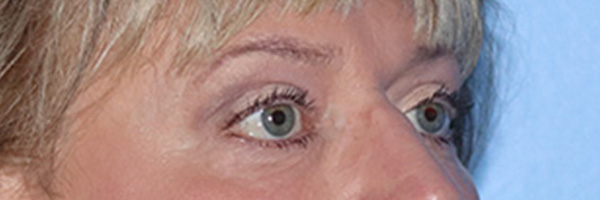 Eyelid Surgery Before & After Gallery - Patient 168494313 - Image 4