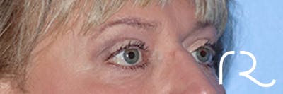 Eyelid Surgery Before & After Gallery - Patient 168494313 - Image 4