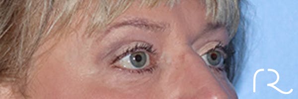 Eyelid Surgery Before & After Gallery - Patient 168494313 - Image 4