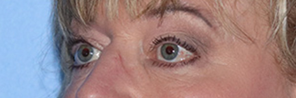 Eyelid Surgery Before & After Gallery - Patient 168494313 - Image 5