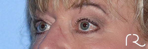Eyelid Surgery Before & After Gallery - Patient 168494313 - Image 5