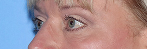 Eyelid Surgery Before & After Gallery - Patient 168494313 - Image 6
