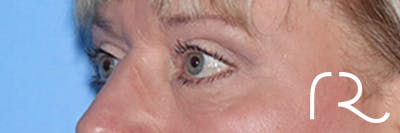 Eyelid Surgery Before & After Gallery - Patient 168494313 - Image 6