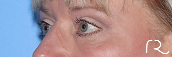 Eyelid Surgery Before & After Gallery - Patient 168494313 - Image 6