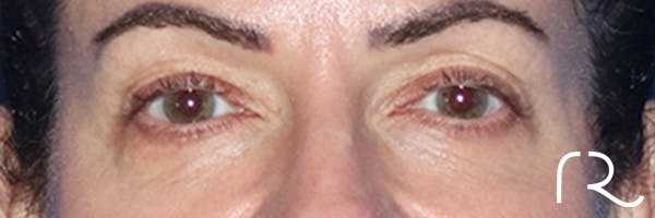 Eyelid Surgery Before & After Gallery - Patient 168494680 - Image 1