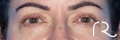 Eyelid Surgery Before & After Gallery - Patient 168494680 - Image 2