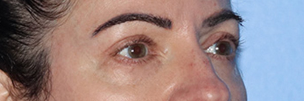 Eyelid Surgery Before & After Gallery - Patient 168494680 - Image 4