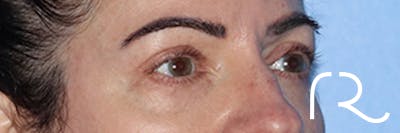 Eyelid Surgery Before & After Gallery - Patient 168494680 - Image 4
