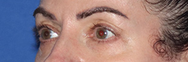Eyelid Surgery Before & After Gallery - Patient 168494680 - Image 5