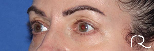 Eyelid Surgery Before & After Gallery - Patient 168494680 - Image 5