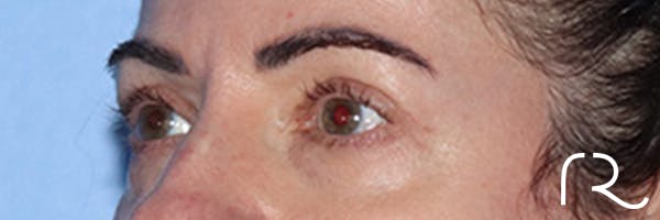 Eyelid Surgery Before & After Gallery - Patient 168494680 - Image 6