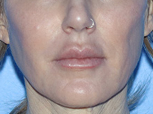 Lip Lift Before & After Gallery - Patient 168494178 - Image 1