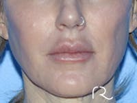 Lip Lift Before & After Gallery - Patient 168494178 - Image 1