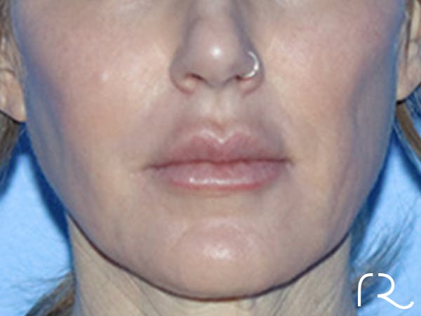 Lip Lift Before & After Gallery - Patient 168494178 - Image 1