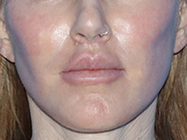 Lip Lift Before & After Gallery - Patient 168494178 - Image 2