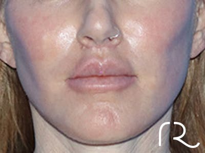 Lip Lift Before & After Gallery - Patient 168494178 - Image 2